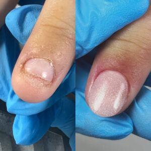 MASTERCLASS UÑAS MORDIDAS