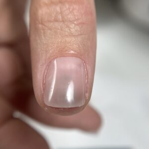 Enfermedades de las uñas